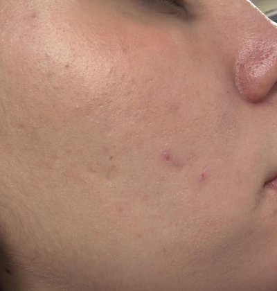 After acne treatment