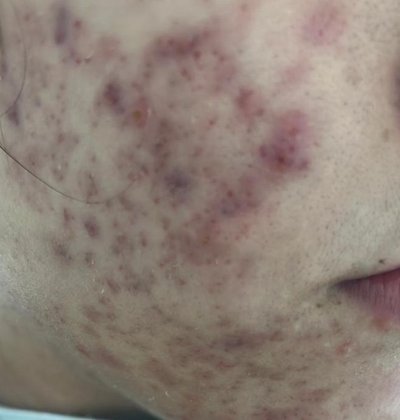 Before acne treatment