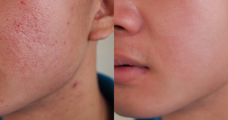 Before and after acne scar treatment
