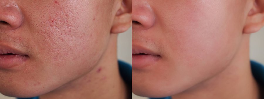 Before and after acne scar treatment at Ella Beauty Skin Care in Newark, NJ