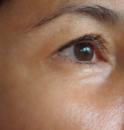 After eye area wrinkle reduction treatment