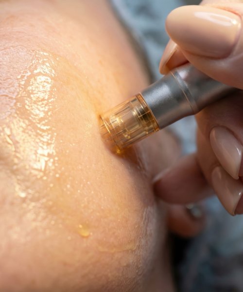 Microneedling with exosomes golden serum treatment