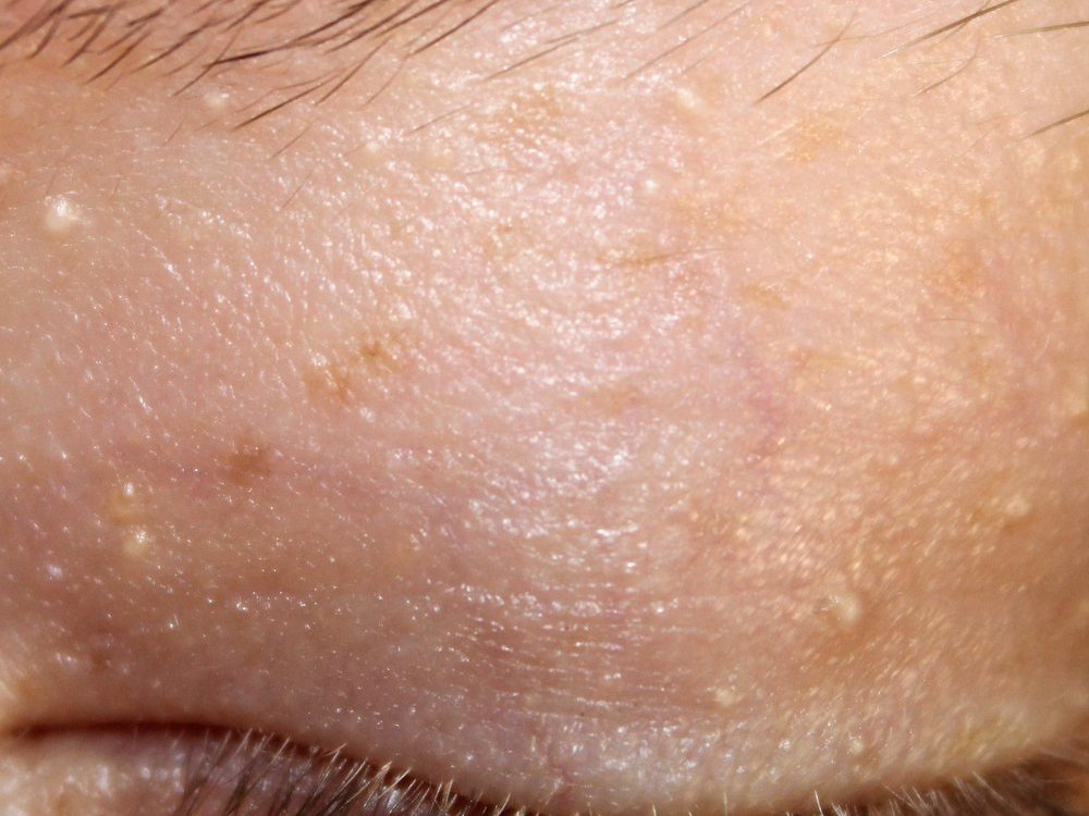 Milia, small white keratin bumps around the eyelid and brow, treated at Ella Beauty Skin Care in Newark, NJ