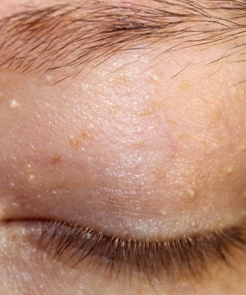 Milia, small white keratin bumps around the eyelid and brow, treated at Ella Beauty Skin Care in Newark NJ