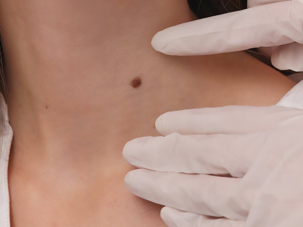 Professional skin tag removal treatment at Ella Beauty Skin Care in Newark, NJ