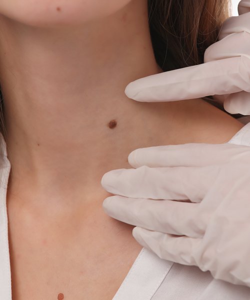 Professional skin tag removal treatment