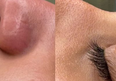 Before and after skin tag removal