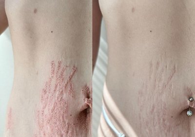 Before and after stretch mark treatment