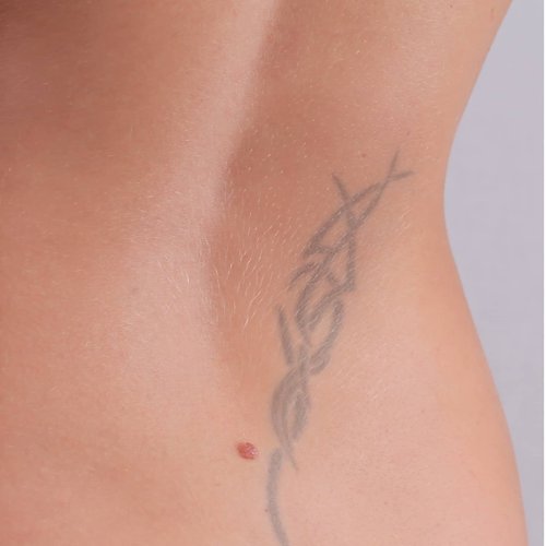 During tattoo removal treatment