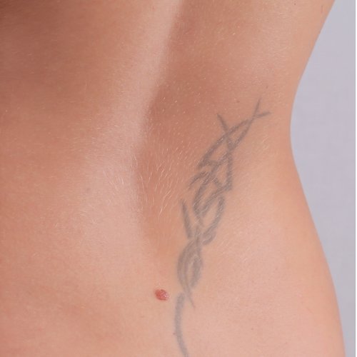 During tattoo removal treatment