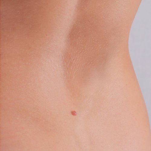 After tattoo removal treatment