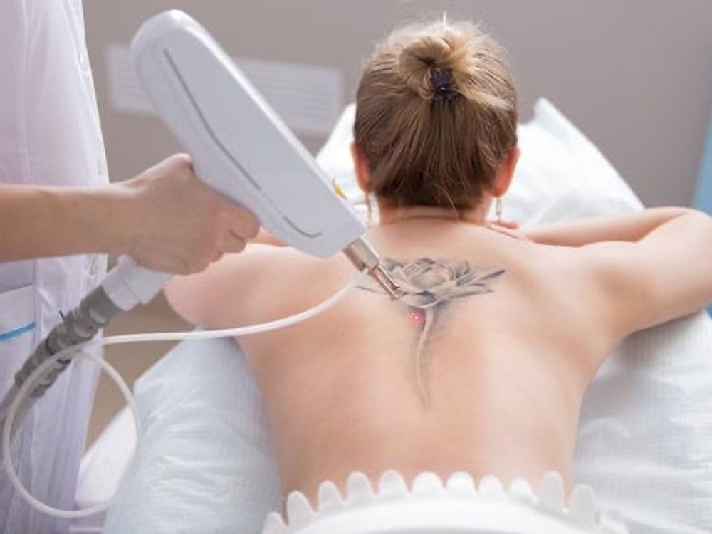 Laser tattoo removal treatment at Ella Beauty Skin Care in Newark, NJ