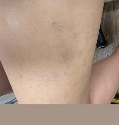 After spider vein removal