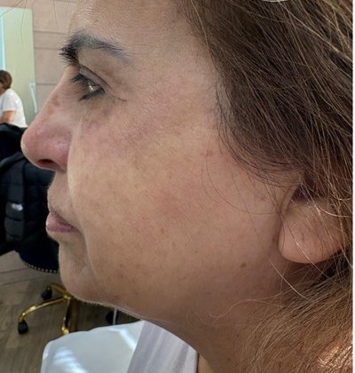 After full face lifting treatment